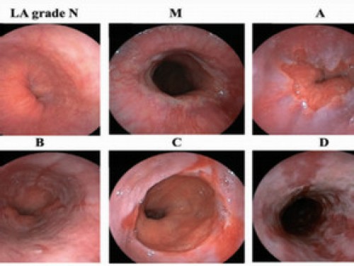 Viêm thực quản trào ngược theo phân loại Los Angeles cải tiển