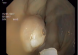 [VIDEO] Nội soi cắt Polyp và kẹp clip trên mô hình đại tràng lợn
